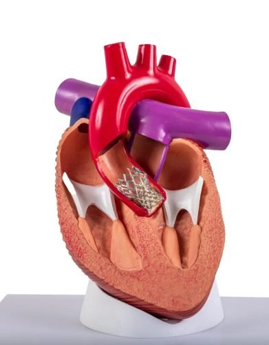 3D-anatomical-model-of-a-heart-with-a-Transcatheter-Aortic-Valve-Replacement-TAVI-device-in-place-scaled